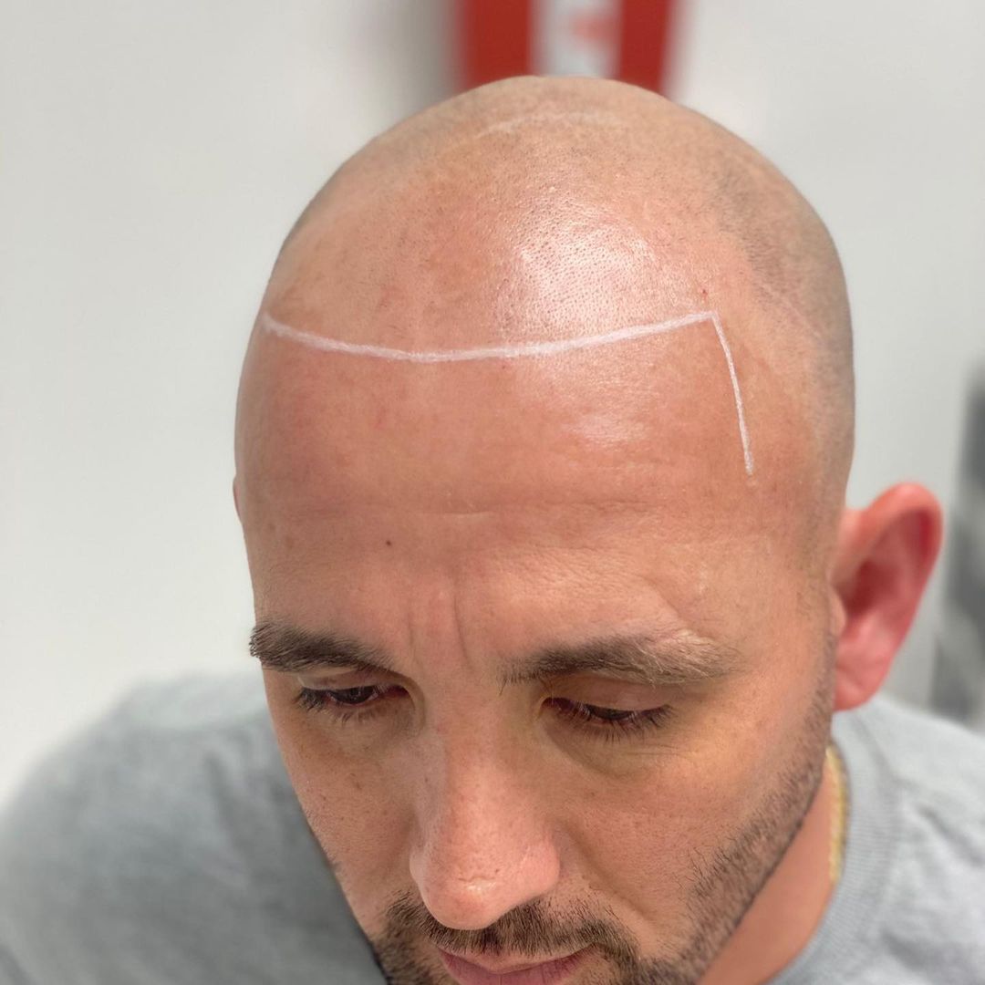 Mr Cutz SMP | Scalp Micropigmentation